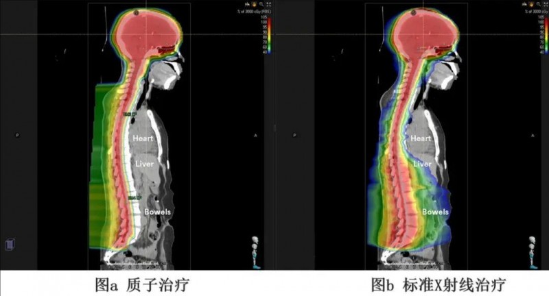 日本质子治疗