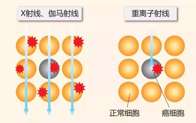 质子重离子治疗