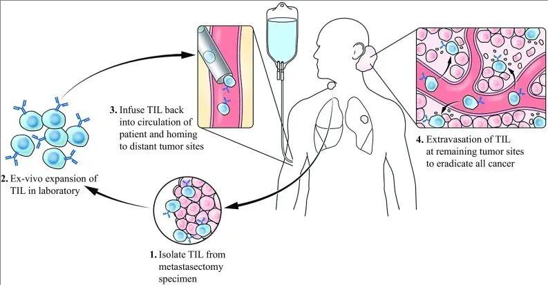TIL细胞疗法主要治疗过程示例图