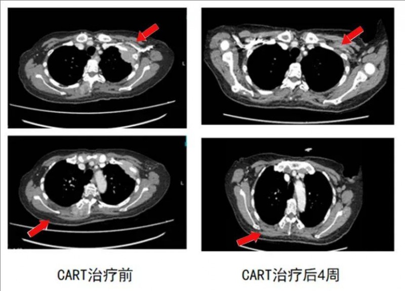 BCMA CAR-T治疗骨髓瘤的效果