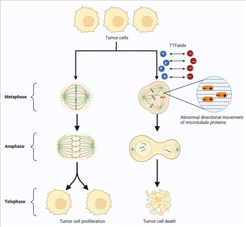 电场疗法(TTFields)干扰肿瘤细胞有丝分裂的模型