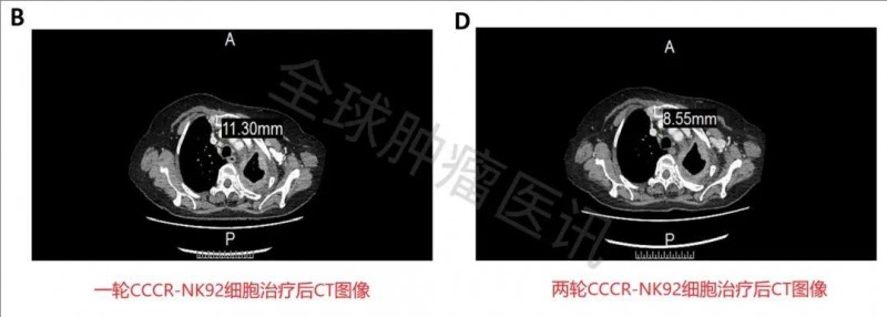 CCCR-NK92细胞疗法治疗肺癌的效果