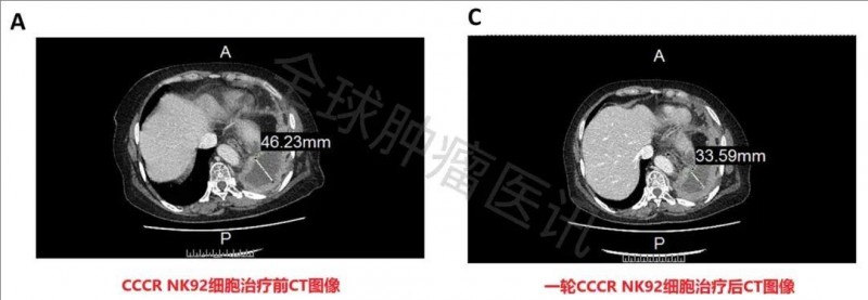 CCCR-NK92细胞疗法治疗肺癌胸腔积液的效果