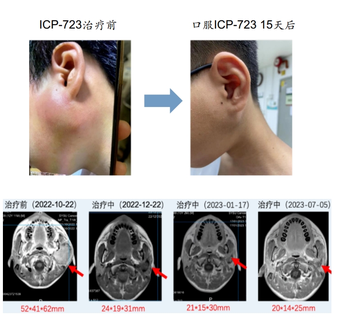 icp723用药