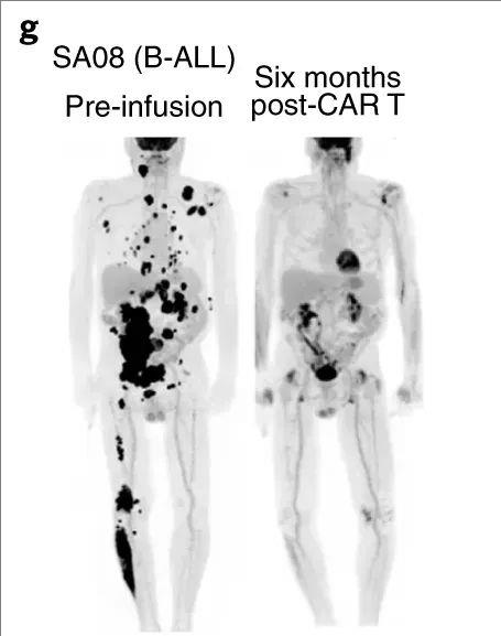 CAR-T细胞疗法治疗B细胞淋巴细胞白血病的效果