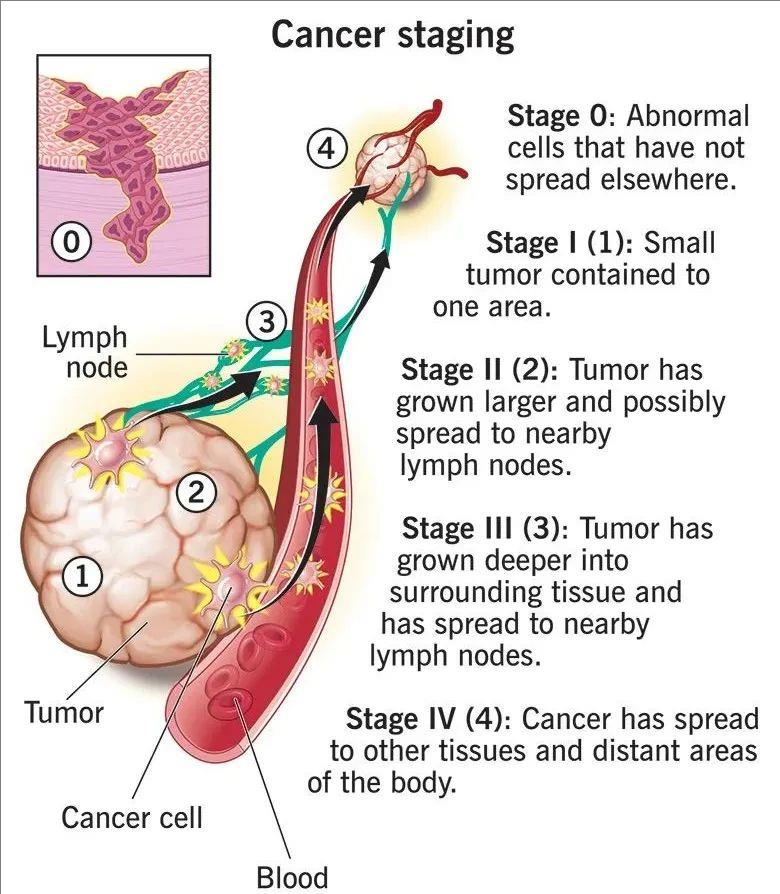 癌症分期