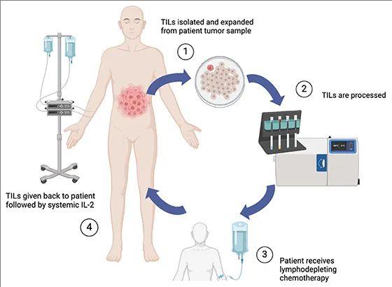 TIL细胞疗法的治疗过程示例图