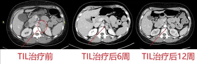 TIL细胞疗法治疗黑色素瘤的效果